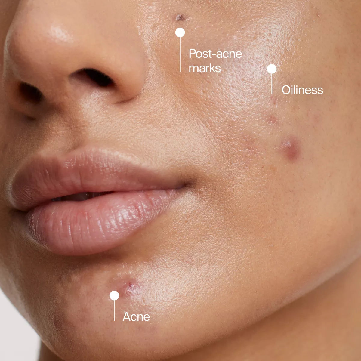 Neutrogena Evenly Clear Acne Cleansing Mask with Benzoyl Peroxide - 4.2 Fl Oz: No Fragrance Added, Vegan, Noncomedogenic