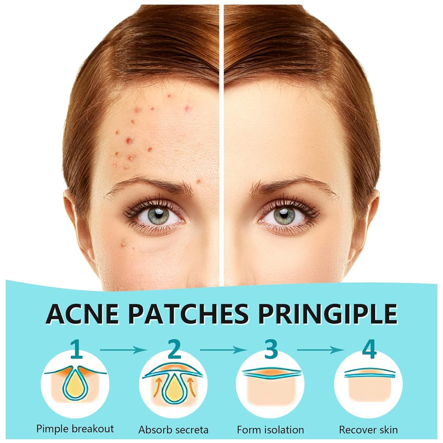 Transform Your Skin Overnight with 180 Count Hydrocolloid Acne Patches - Clear, Invisible Pimple Treatment Stickers for All Skin Types